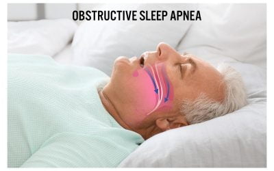 Obstructive Sleep Apnea